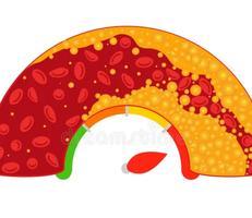 Hyperlipidemia / Elevated Cholesterol